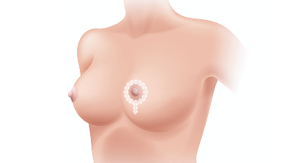 보형물 삽입공간 확보