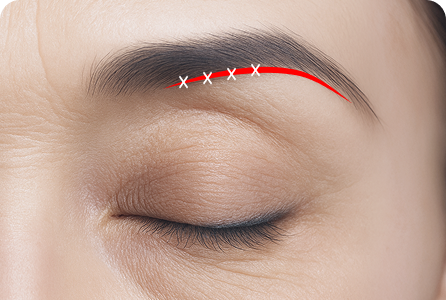 뼈막에 고정 후 피부 봉합