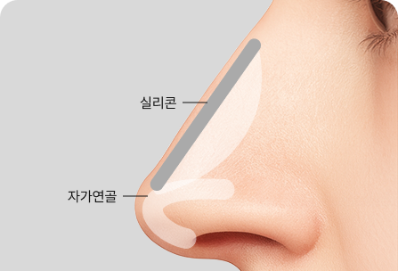 맞춤형 보형물 삽입