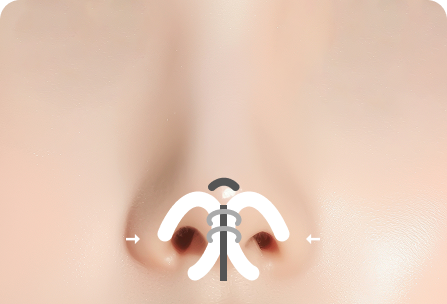 연골 사이 기둥 삽입과 코 끝 연골 이식