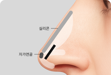 연골성형술+연골이식술+융비술